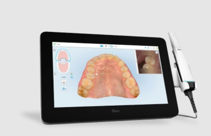 itero digital scanning