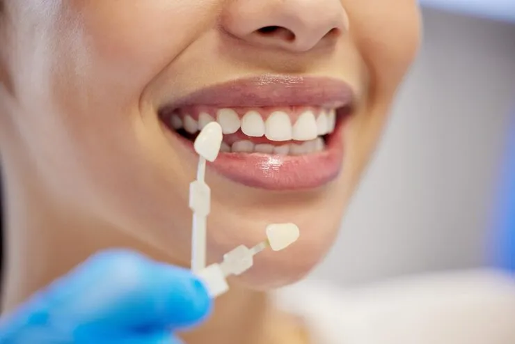 dental veneers treatment guide